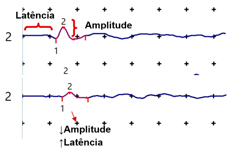 Comparação de duas curvas de eletroneuromiografia indicando latência e amplitude. No traçado inferior a latência aumenta e a amplitude diminui, padrão típico de compressão do nervo mediano.